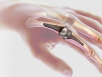 Parmak İmplantı Testleri Hizmetlerimiz (Finger Implants Testing Services)
